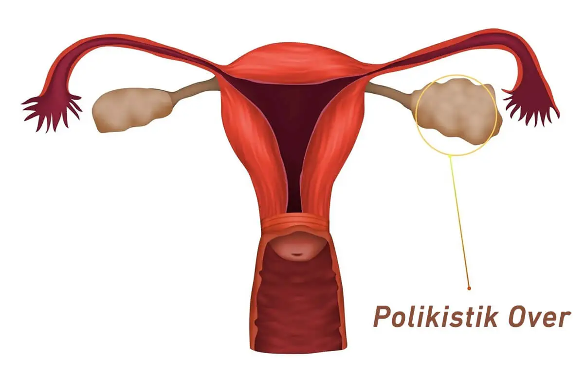 PCOS Belirtileri Nelerdir? — Polikistik Over Sendromu Nasıl Anlaşılır?